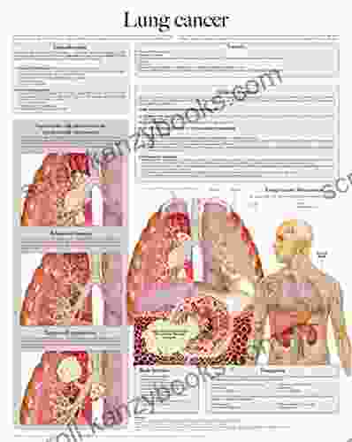 Lung Cancer E Chart: Full Illustrated