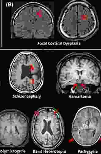 MRI in Epilepsy (Medical Radiology)